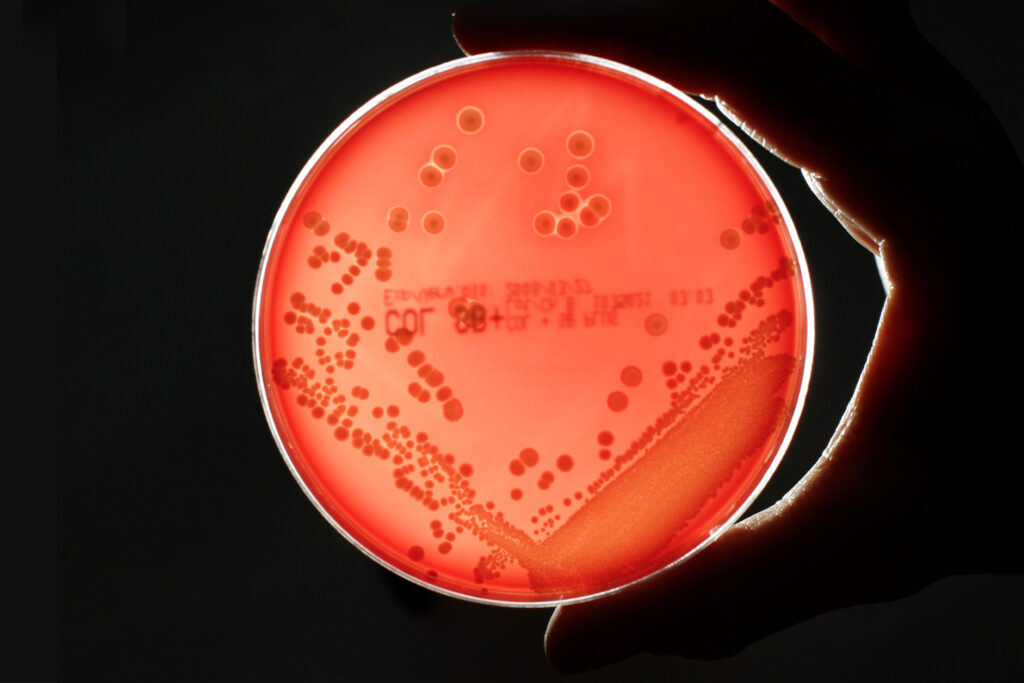 MRSA (Methicillin-resistant Staphylococcus aureus) bacteria strain is seen in a petri dish containing agar jelly for bacterial culture in a microbiological laboratory. MRSA is a drug-resistant "superbug", which can cause deadly infections.