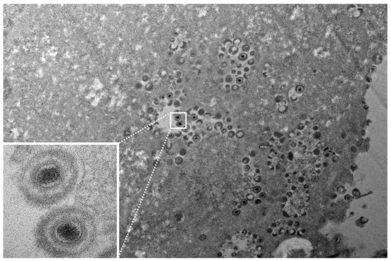 transmission electron microscope image shows the varicella-zoster virus