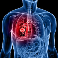 Lung cancer illustration